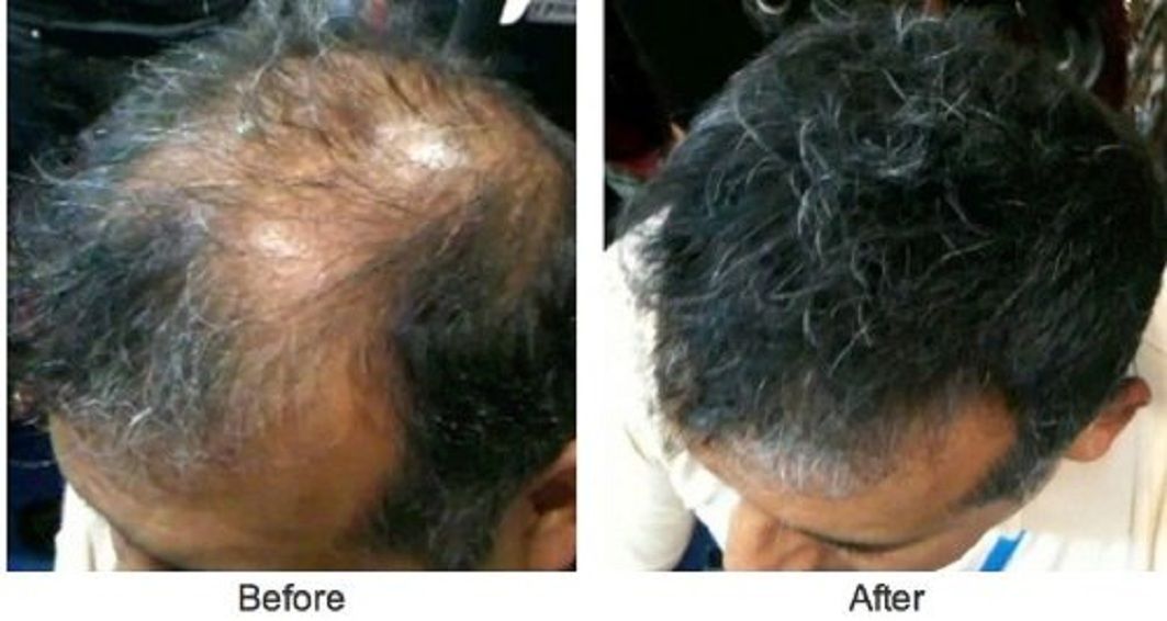 caboki hair loss treatment black